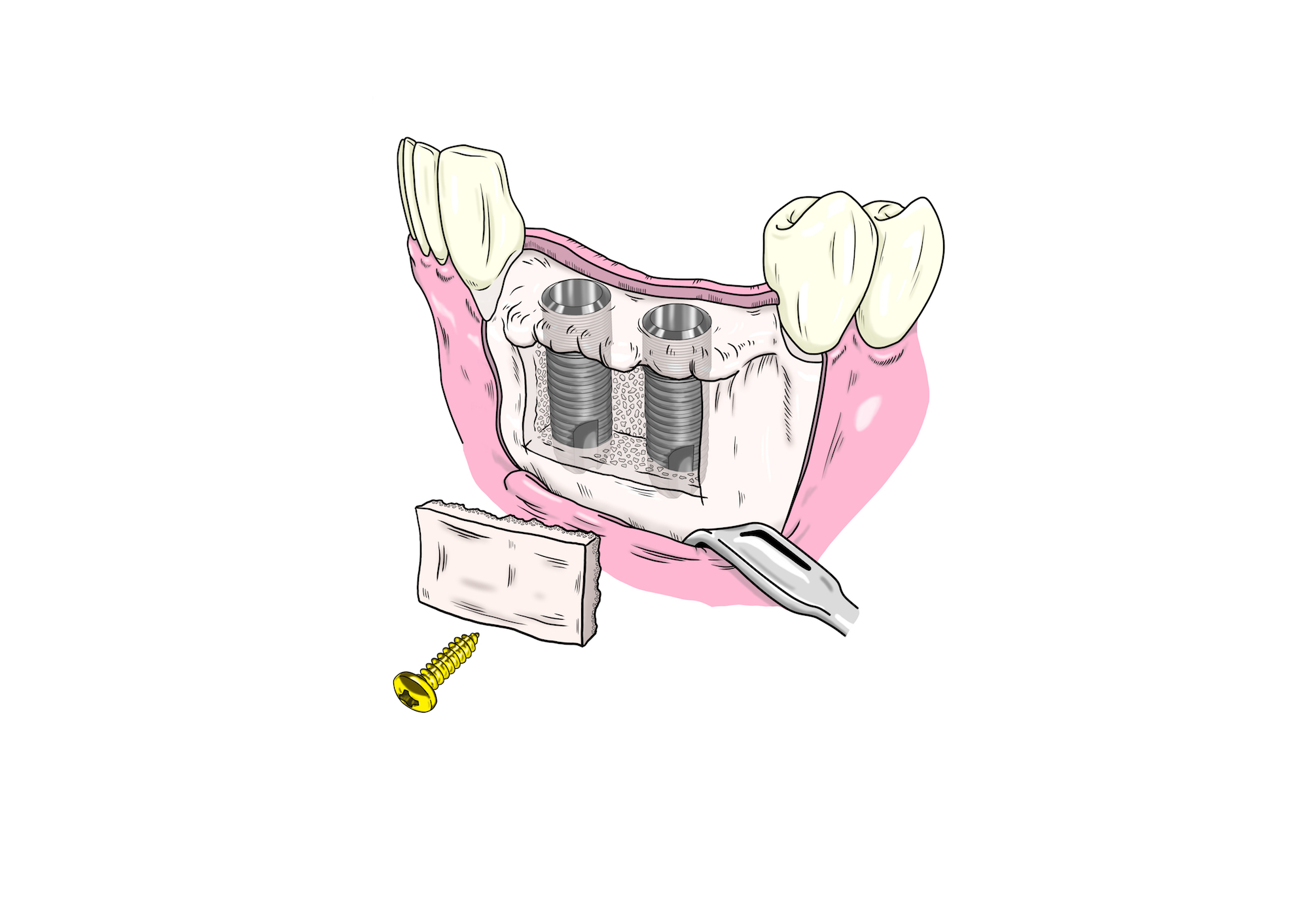 小山慶介イラスト　Keisuke Koyama cortical bone repositioning