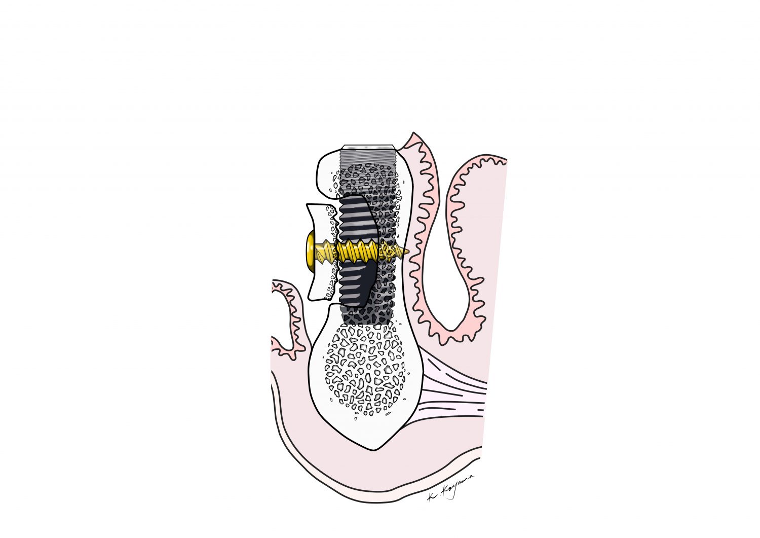 小山慶介イラスト　Keisuke Koyama cortical bone repositioning