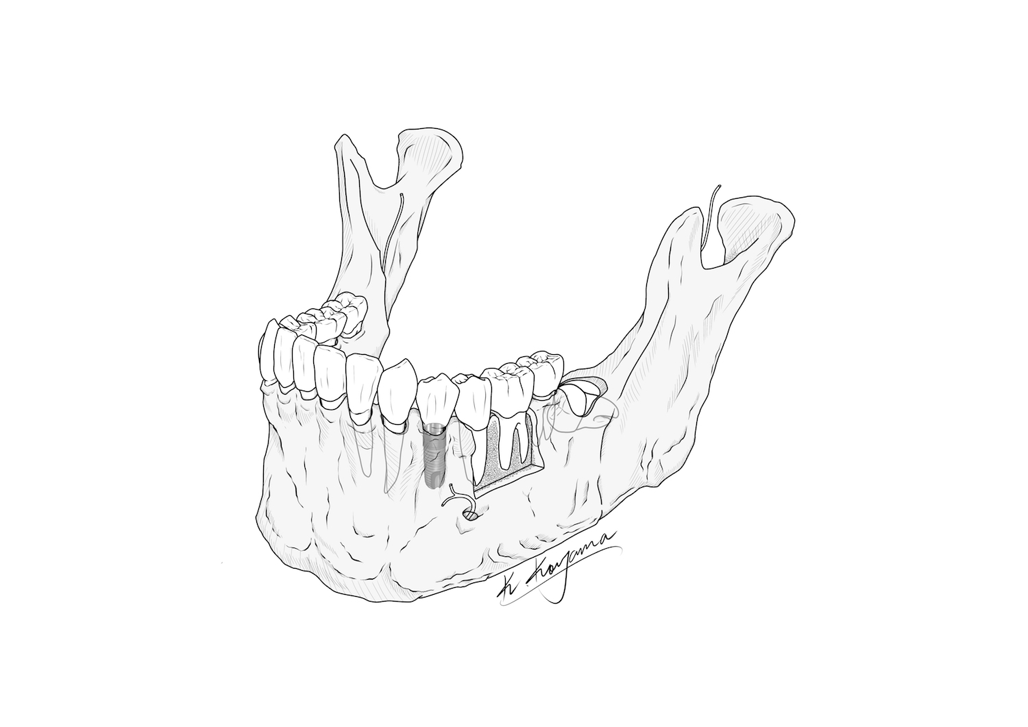 下顎骨イラスト・小山慶介