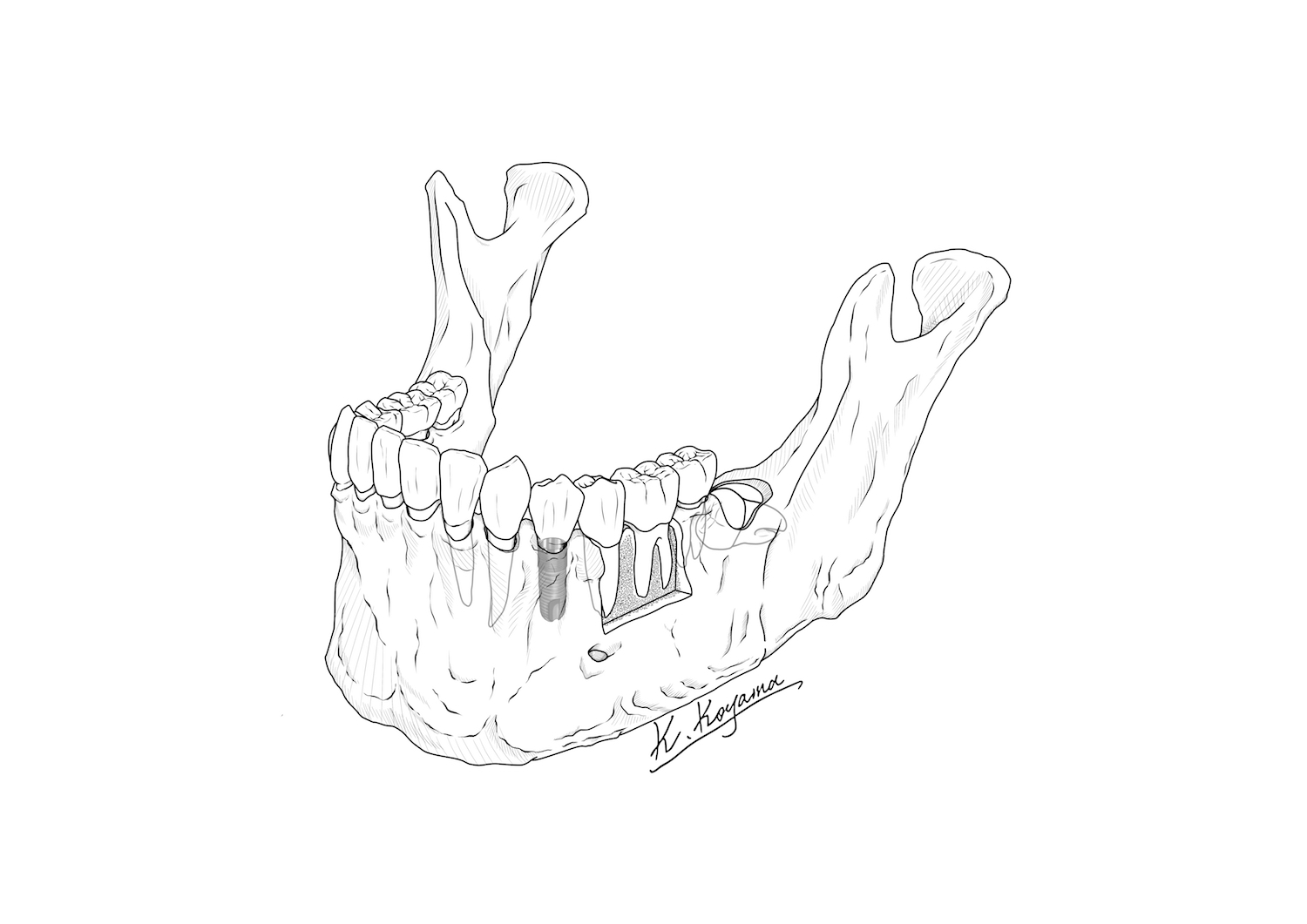 下顎骨イラスト・小山慶介